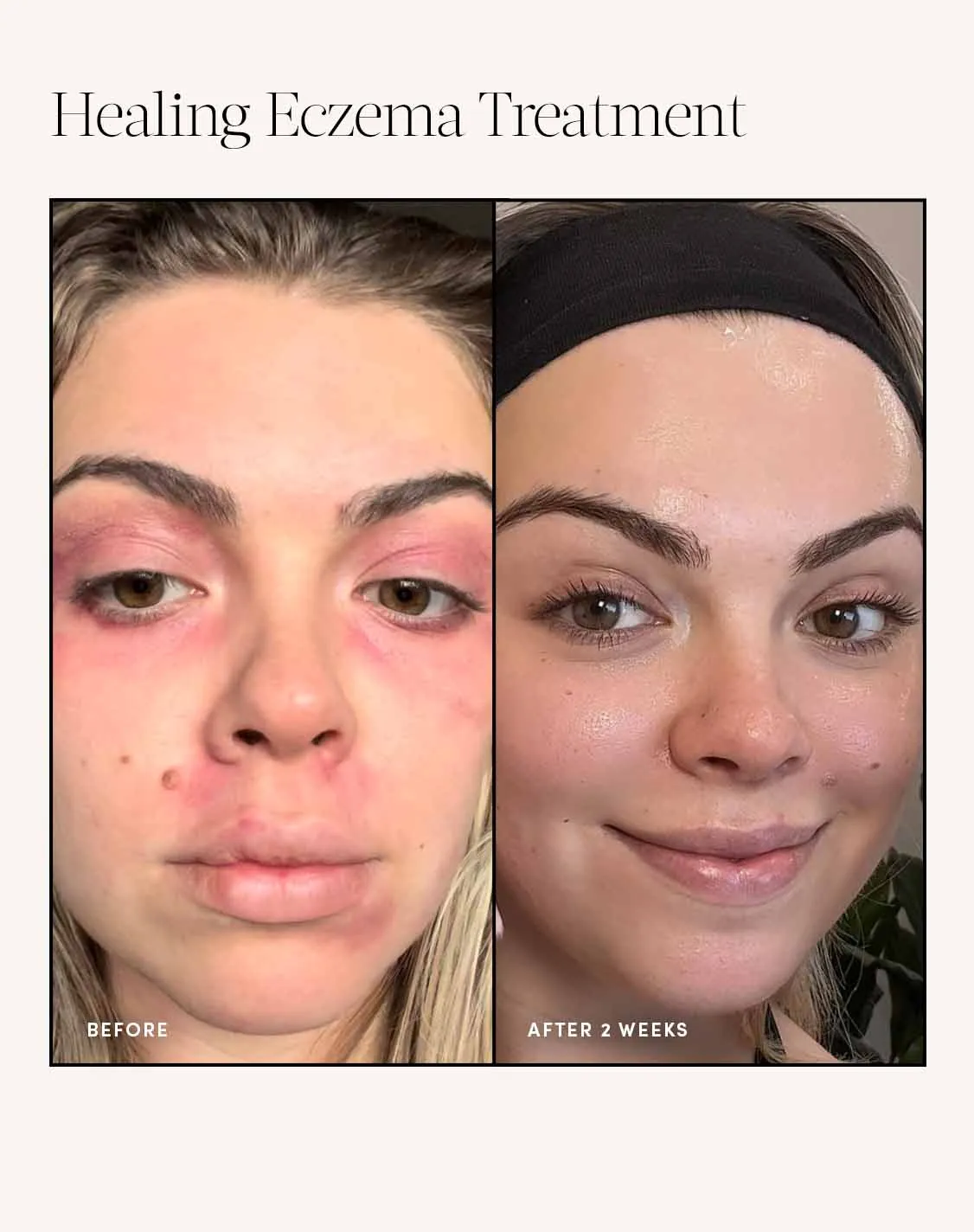 Healing Eczema Duo